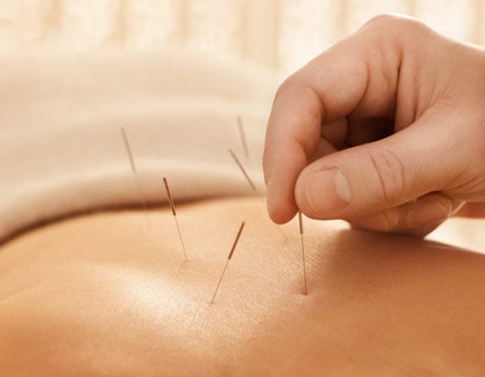 La-acupuntura-puede-ayudar-cuando-se-trata-de-concebir-686x533