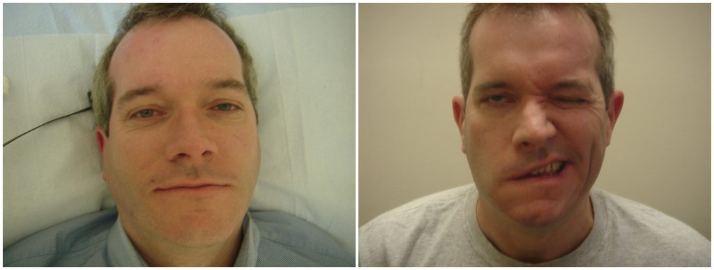 Acupuncture for Bell’s palsy