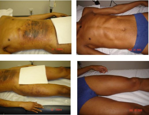 Acupuncture and Chinese Herbal formula for Eczema