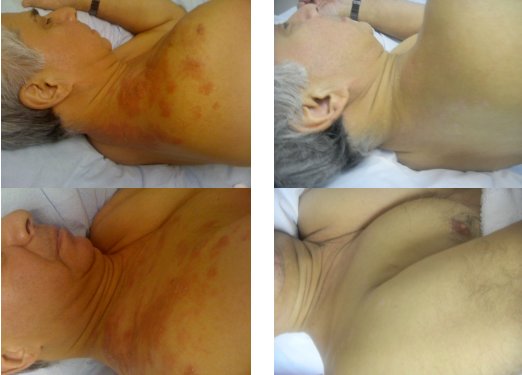 Acupuncture for Shingles