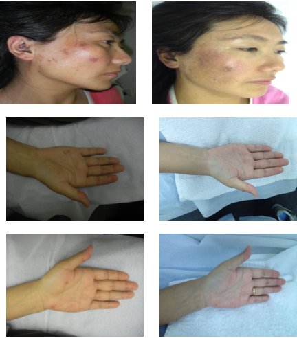 Acupuncture and Chinese Herbs for Lupus