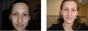 Acupuncture for Skin Rashes and weaker Immune System