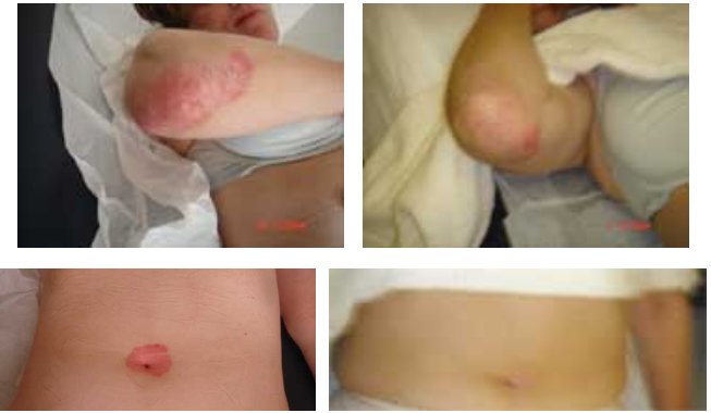 Acupuncture treatment of psoriasis
