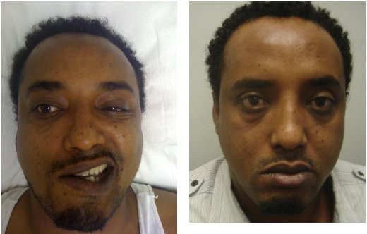 Acupuncture for Bell’s palsy