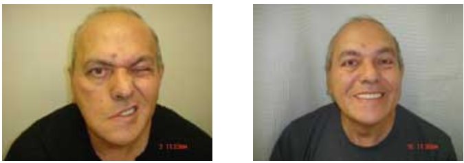 Acupuncture for palsy