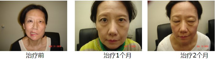 Acupuncture for Bell ’s palsy