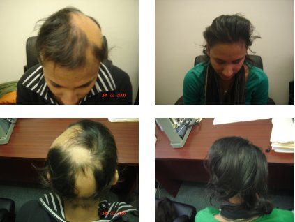 Acupuncture treatment of hair loss
