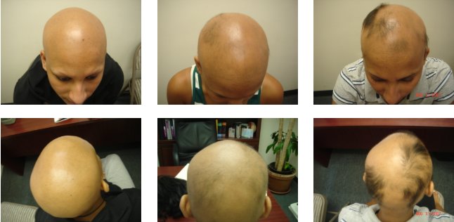 Acupuncture treatment of hair loss