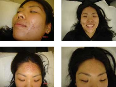 Acupuncture for Acne