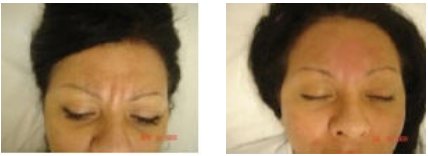 Acupuncture for Wrinkles Removed