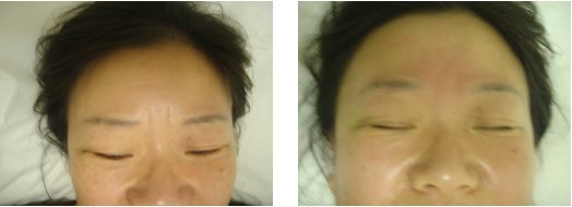 Acupuncture for Removing Wrinkles