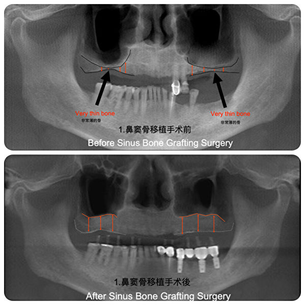 当患者骨量不够时，可以通过骨质再生重建口腔中失去的骨骼，并将种植体放置到正确的位置。图为鼻窦处骨骼不够时进行补骨前后骨头的厚度对比。（Plaza Dental Implant Center提供）