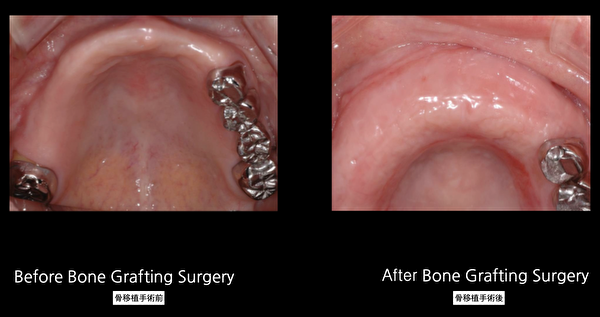 补骨（植骨）前后的牙槽骨对比。（Plaza Dental Implant Center提供