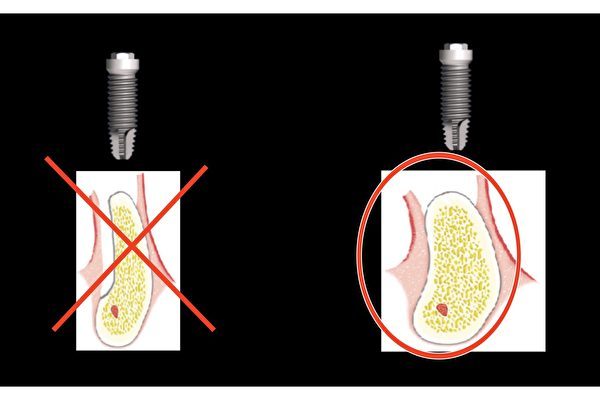 植牙前首先要考虑的重要事情是口腔的骨量是否能够支撑一颗假牙，骨量不足（如左图所示）容易造成种植失败。（Plaza Dental Implant Center提供）