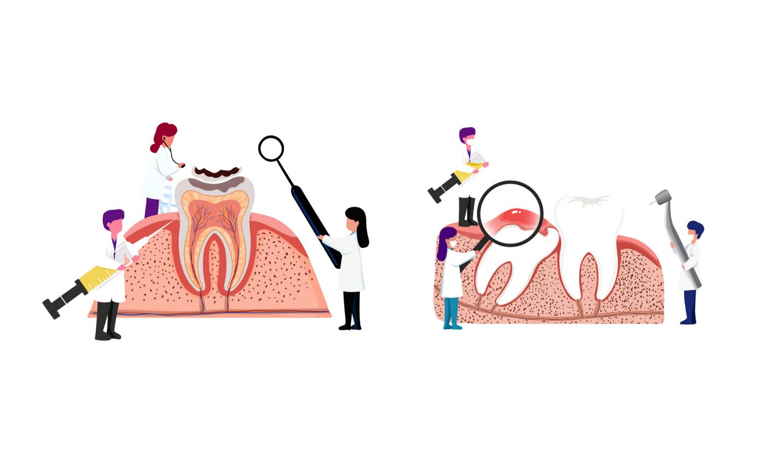 牙周病可以自己治疗吗,牙周病,口腔卫生,牙齿松动,牙龈组织