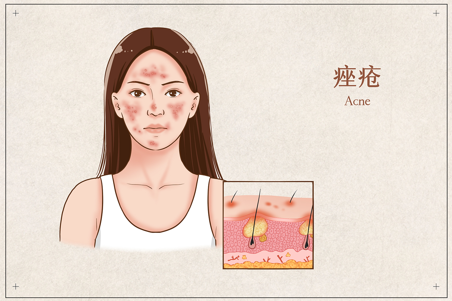 痤疮疤痕
