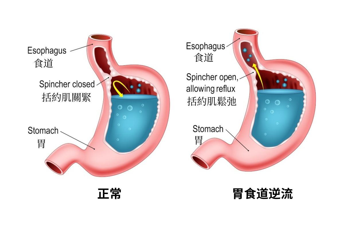 胃食管反流咳嗽
