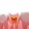 牙齿意外脱落或断裂：应对方法及紧急救治