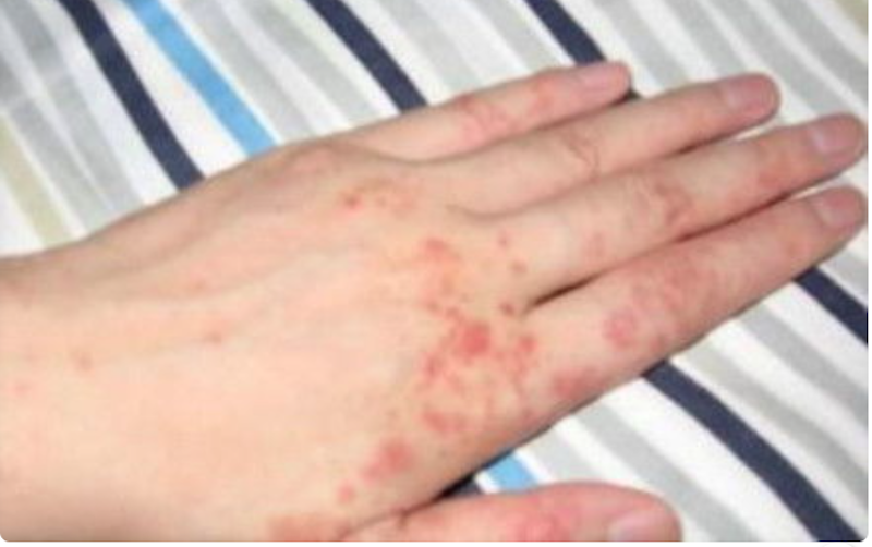 手足湿疹全面解析——症状、原因、诊断、治疗、日常护理及禁忌//皮肤病 皮肤科 医生