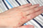 手足湿疹全面解析——症状、原因、诊断、治疗、日常护理及禁忌//皮肤病 皮肤科 医生