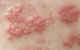 为何湿疹会反复发作？湿疹复发原因有哪些？