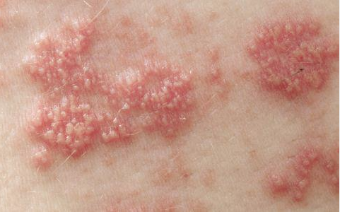 为何湿疹会反复发作？湿疹复发原因有哪些？