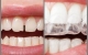 什么是牙齿矫正收缝？牙齿矫正过程中如何收牙缝？/纽约精典牙科☎️718-888-1817